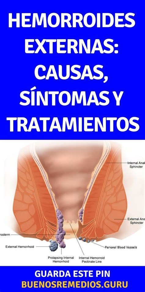 hemorroides externas fotos y videos|Hemorroides externas e internas: qué son y tratamientos 